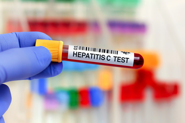 England er på god vei til å bli et av de første landene som utrydder hepatitt C